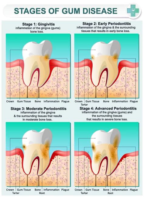 How to Get Rid of Gingivitis: Treatment for Bleeding Gum Disease | Diet vs Disease