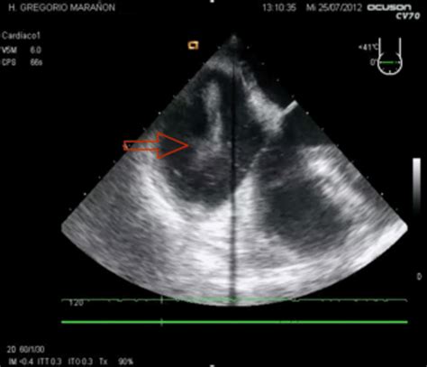 Echocardiography findings in a massive pulmonary embolism (PE), with... | Download Scientific ...