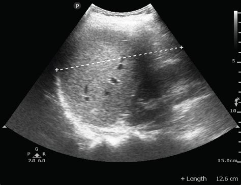 Normal Vs Fatty Liver Ultrasound