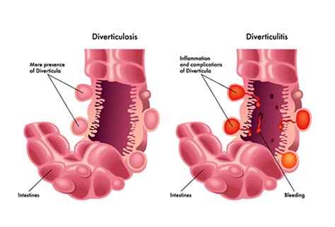 How To Avoid Diverticulitis » Kidnational