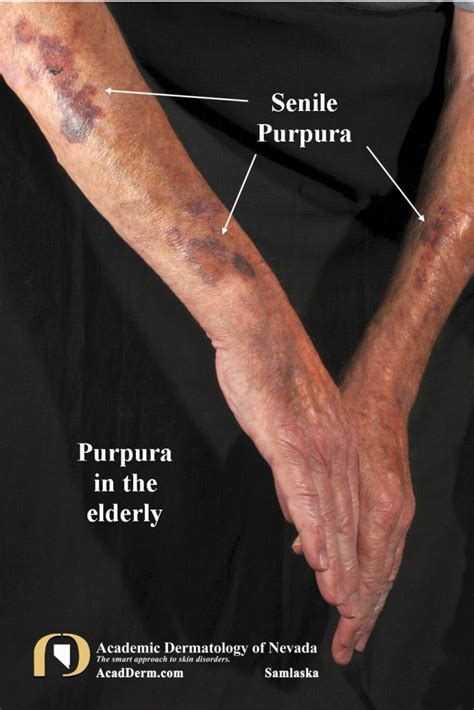 Senile Purpura: Bruising In The Elderly... - Academic Dermatology of Nevada