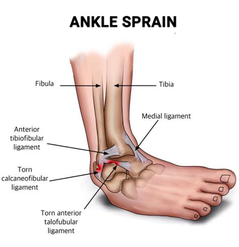 Sprained Ankle Treatment, Recovery | Clifton and Wayne, NJ