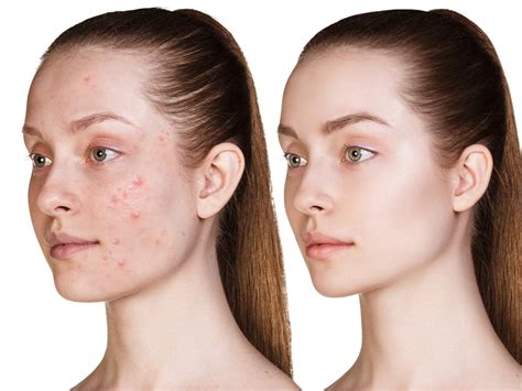 Laser Acne Treatment: Baton Rouge, LA | Body Image Aesthetics