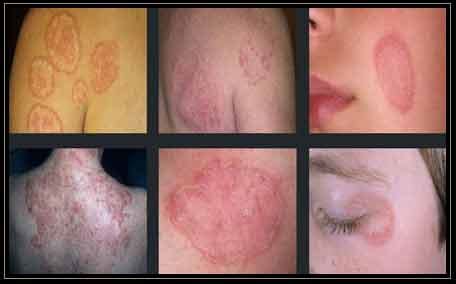 Ringworm (Tinea Corporis) | Faces Cosmetic Lasers Center