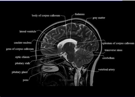 Brain Lobes Labeled Mri at Harold Cook blog