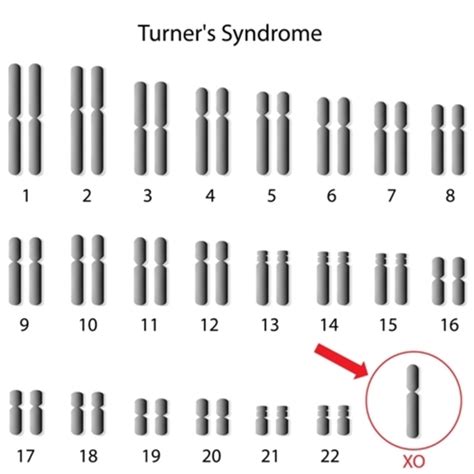 Turner syndrome: MedlinePlus Genetics