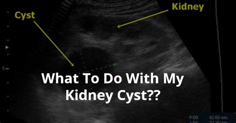 Wellness Lab Health Info: What To Do With My Kidney Cyst??