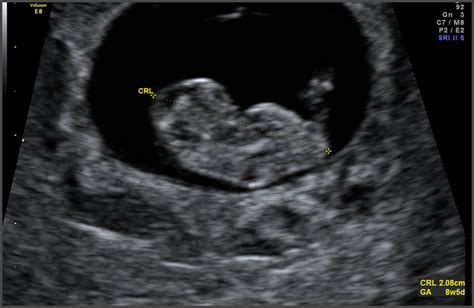 What Does A Baby Look Like At 8 Weeks Ultrasound - Baby Viewer