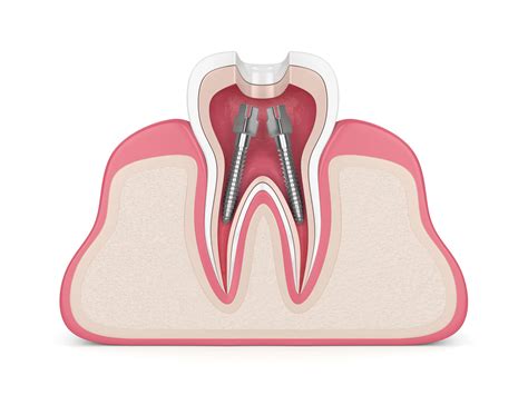 What Is a Root Canal Procedure? - Park Plaza Dental