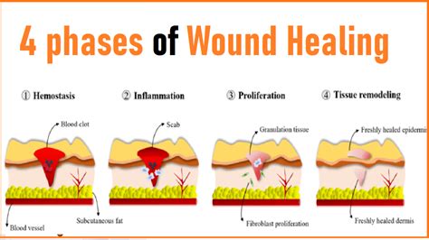 The Four Phases of Wound Healing: A Guide to the Wound Healing Process - NursingNotes