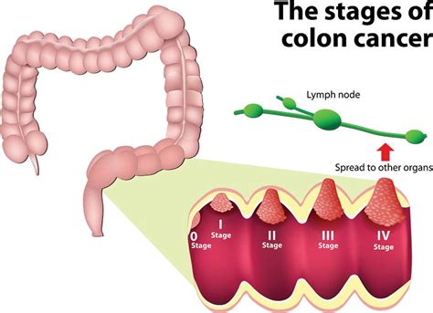 Colon Cancer Stages | Moffitt