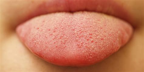 Oral Thrush - What Bumps on Your Tongue May Be Telling You | HuffPost