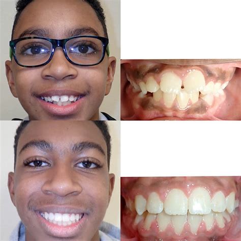 Before & After Braces | Wazio Orthodontics