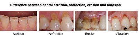 What is the difference between dental attrition, abfraction, erosion ...