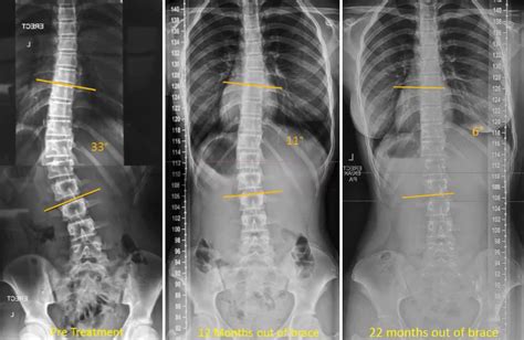 Scoliosis Before And After