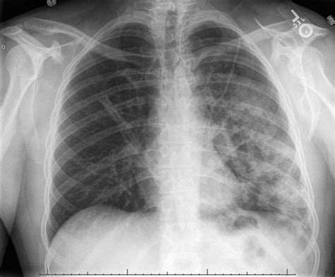 Pneumothorax Imaging