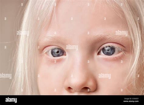 close-up photo of beautiful blue eyes of albino child girl looking side ...