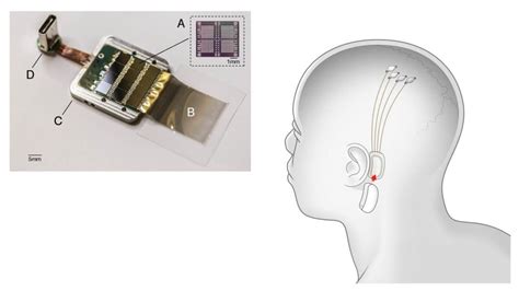 Enjoy music inside your head with Elon Musk's Neuralink Brain chip implant - TheQnA.Org