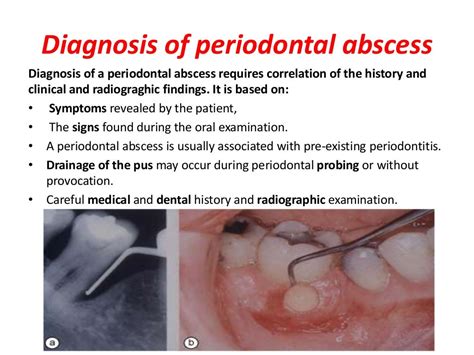 Periodontal pocket