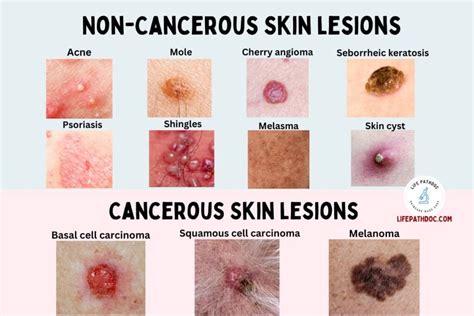 Skin Lesions: Types with Chart, Pictures, Causes, Treatment