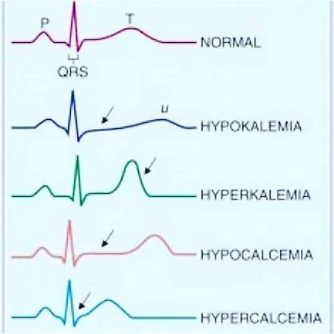 Hypocalcemia And Ecg Changes