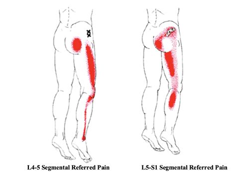 Diagnosing Lateral Thigh Pain: IT band syndrome, Hip Bursitis and referred Back pain - Reid ...