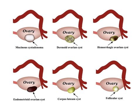 Ovarian cysts symptoms, treatment of ruptured ovarian cyst - Cancer care and treatment