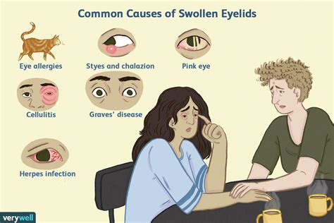 Top Causes of Swollen Eyelids (2023)