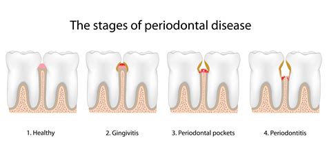 Stages of Gum Disease - Boston, MA - Oral Health Care