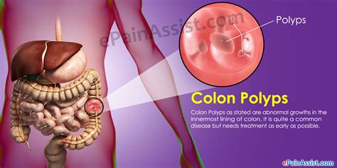 Colon Polyps: Symptoms, Types, Causes, Prevent & Pictures