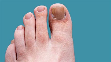 15 home remedies for toenail fungus – Cooking AMOUR