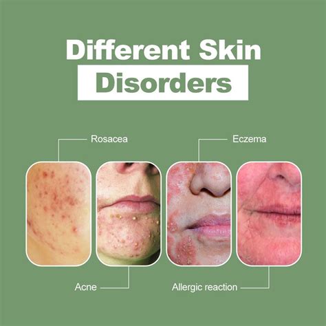 different skin disorders Natural Remedies For Rosacea, Rosacea Remedies ...