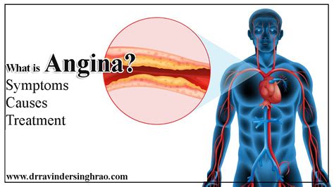 Angina And Heart Attack Difference Causes, Symptoms,, 56% OFF