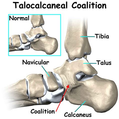 Tarsal coalition causes, symptoms, diagnosis & treatment