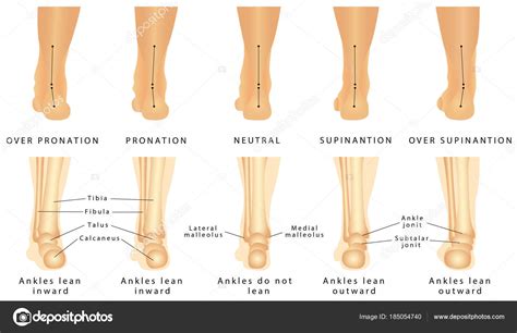 Foot Deformation Valgus Varus Defect Normal Human Foot Foot Pronation Stock Vector by ©anutuno ...