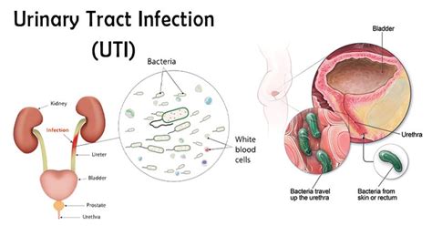 Types of Urinary Tract Infections | Symptoms | Causes | Treatment - Sutured