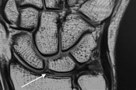 Scapholunate Ligament Mri