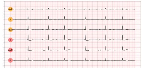 Third-degree AV block (3rd degree AV block, AV block 3, AV block III ...