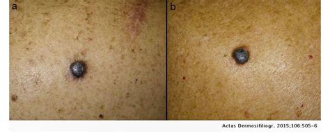 Melanoma On Lip Pictures In English - Infoupdate.org