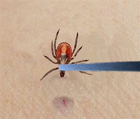 Tick Removal From Humans