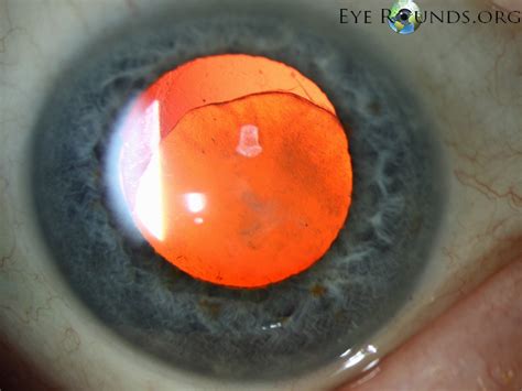 Atlas Entry - Morgagnian cataract with absent cortex