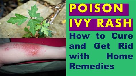 Get Rid Of Poison Ivy Rash