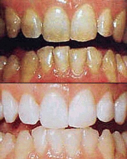 The effects of accutane on bleached teeth | Intelligent Dental