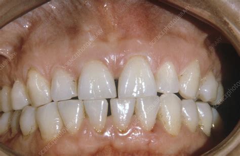 Dental abrasion - Stock Image - C023/5499 - Science Photo Library