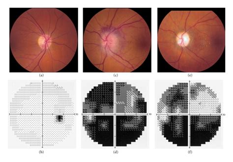 Nonarteritic anterior ischemic optic neuropathy (NAION) in the left eye ...