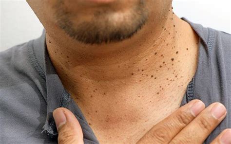 Skin Tags And Its Causes - Dr. Walia's Skin And Laser Clinic