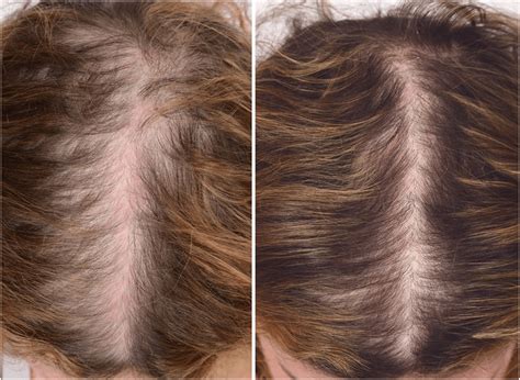 A 46-year-old woman with androgenetic alopecia, before and 3 months... | Download Scientific Diagram