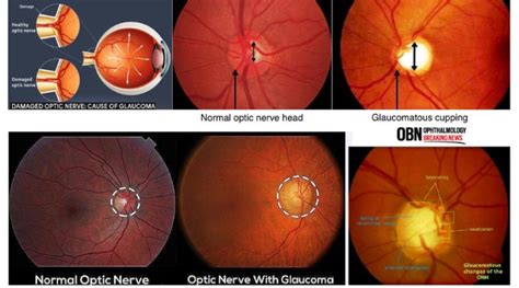 Glaucomatous Optic Nerve Damage | OBN