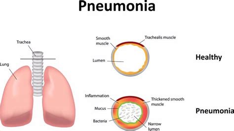 Causes and types of pneumonia