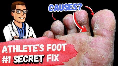 How To Cure Athletes Foot Fungus FAST [HOME Remedies + 3 BIG SECRETS]